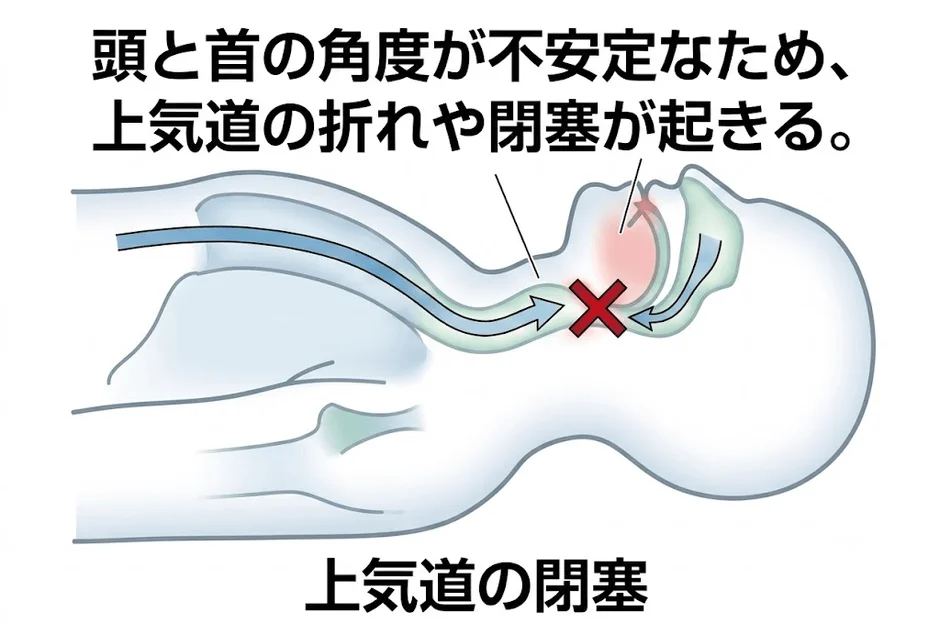 上気道の閉塞