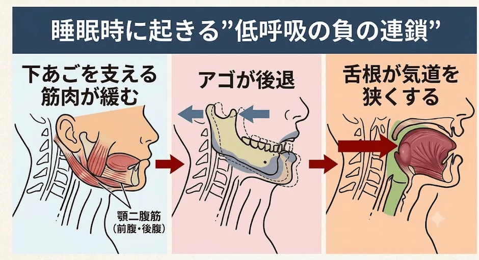 舌根沈下