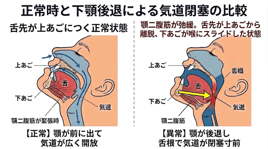 正常時と下顎後退による気道閉塞の比較